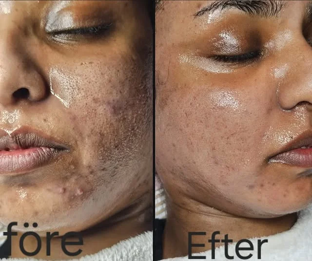 Bio microneedling, algneedling, resultat hos oss