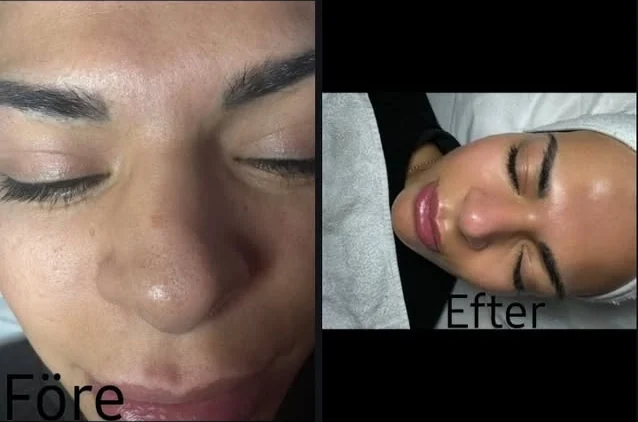 Hydrafacial, före och efter