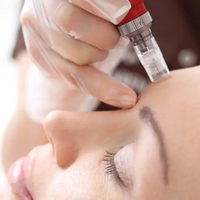 Microneedling med EPN, behandling av ansiktet